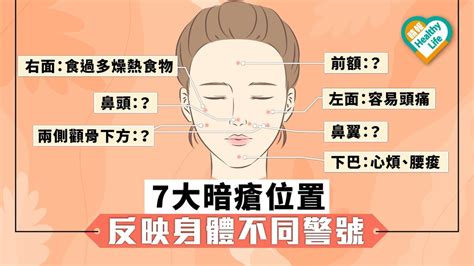 左臉生暗瘡|【暗瘡位置】不同代表什麼？中醫教如何處理及預防